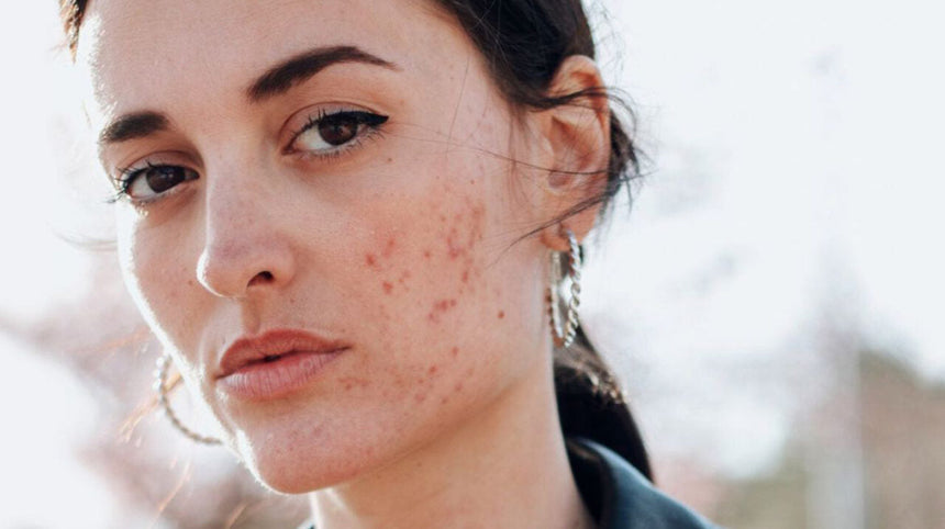 Primo piano di donna con acne