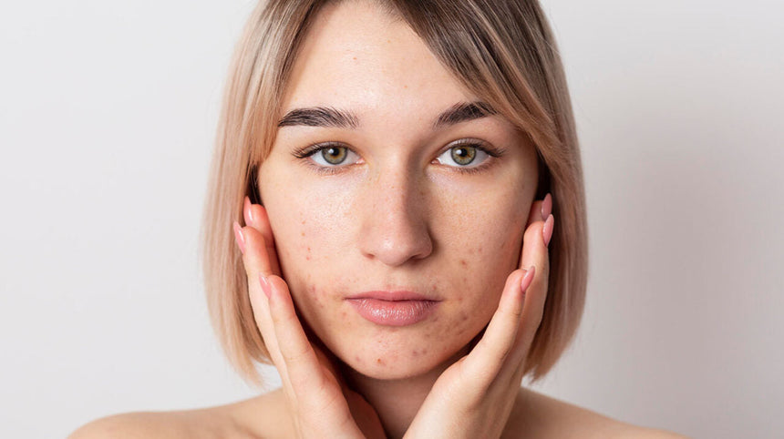 Ragazza con imperfezioni sul viso