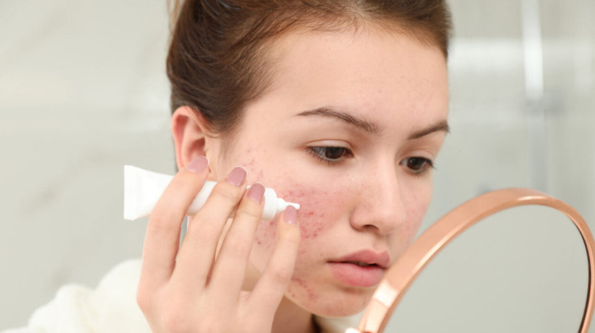 Ragazza con acne sulle guance che applica una crema